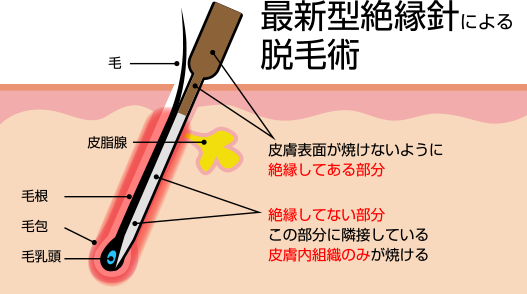 最新型絶縁針による脱毛術